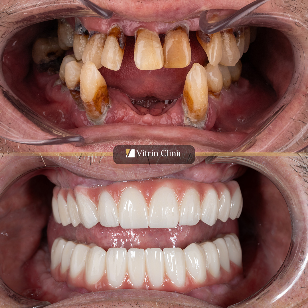 Frank dental implants